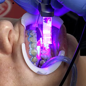 Img-Services-teeth-whitening-medellin