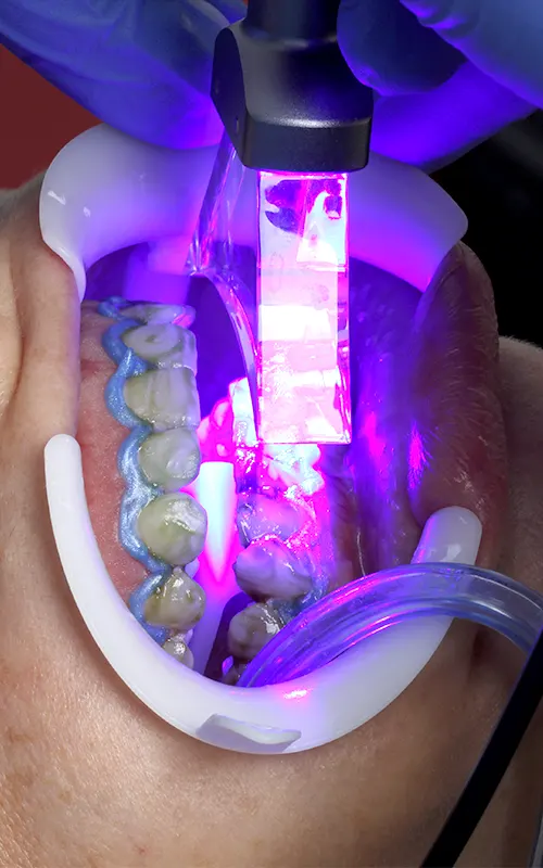 img-teeth-whitening-medellin-2