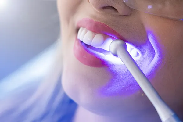 Tener una sonrisa blanca y brillante después de un tratamiento oral estético requiere más que solo disciplina, también es cuestión de hábitos saludables y cuidados constantes. En...