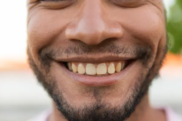 ¿Quieres descubrir cómo blanquear los dientes amarillos y lucir una sonrisa más brillante? Las manchas amarillas en los dientes pueden afectar tu confianza, pero existen soluciones especializadas que garantizan resultados...